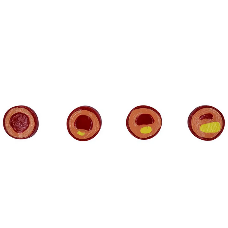 2X Human Atherosclerosis Cardiovascular Model Vascular Anatomy Model Branch Atherosclerosis Teaching Supplies
2X Human Atherosclerosis Cardiovascular Model Vascular Anatomy Model Branch Atherosclerosis Teaching Supplies