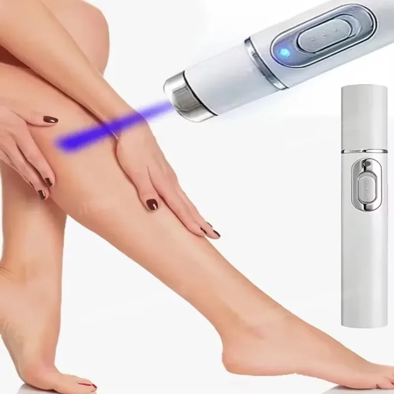 Laser Therapy For Varicose Vein Treatment Effective Relieve Legs Dilated Vasculitis Phlebitis Improve Circulation Blue Light Pen
Laser Therapy For Varicose Vein Treatment Effective Relieve Legs Dilated Vasculitis Phlebitis Improve Circulation Blue Light Pen