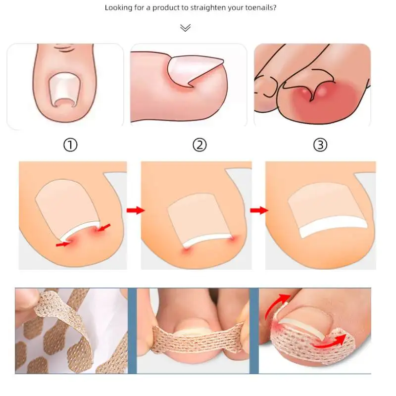 1/100Sheets Adhesive Toenail Patch Ingrown Toe Nail Correction Sticker Foot Corrector Pedicure Health Care Tools Toe Treatment
1/100Sheets Adhesive Toenail Patch Ingrown Toe Nail Correction Sticker Foot Corrector Pedicure Health Care Tools Toe Treatment