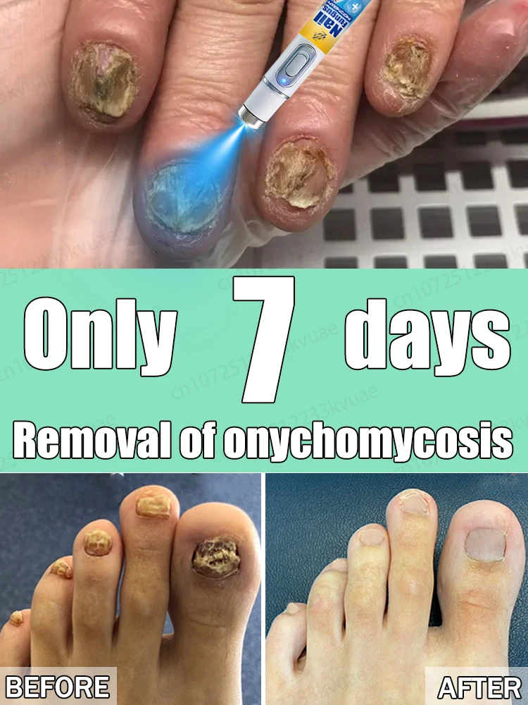 Лазер устраняет онихомикоз, без рецидивов, без повреждения ногтей, научное удаление грибка ногтей
Лазер устраняет онихомикоз, без рецидивов, без повреждения ногтей, научное удаление грибка ногтей