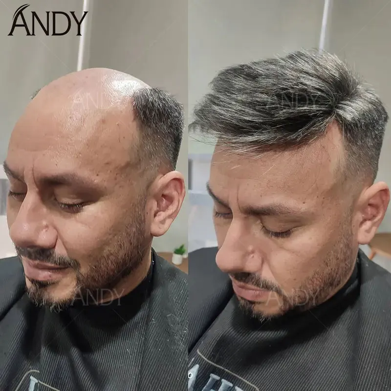 Male Hair Prosthesis 0.12-0.14mm Injection Skin Toupee For Men 100% Brazilian Human Hair Natural Hairline Invisible Men Wigs
Male Hair Prosthesis 0.12-0.14mm Injection Skin Toupee For Men 100% Brazilian Human Hair Natural Hairline Invisible Men Wigs