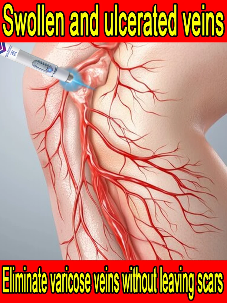 Laser treatment for varicose veins can eliminate vasculitis and phlebitis, relieve spider leg pain,
Laser treatment for varicose veins can eliminate vasculitis and phlebitis, relieve spider leg pain,