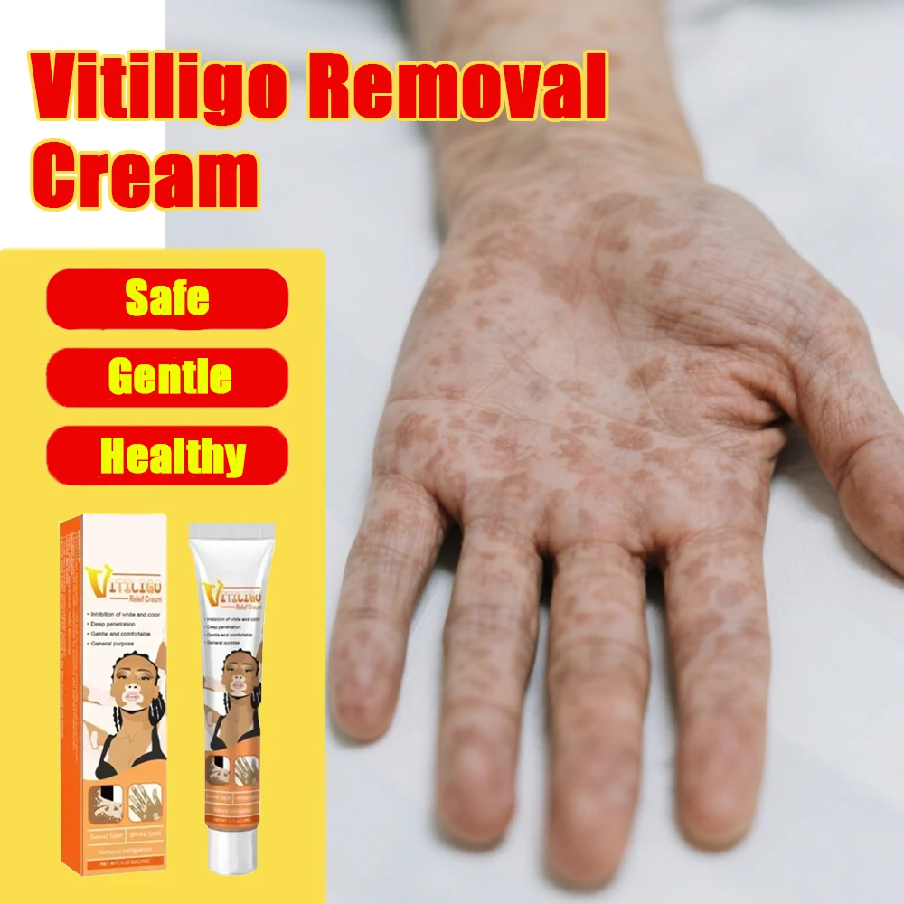 Vitiligo Care Cream for Skin White Spots Reduction Effective Spot Minimizing Formula
Vitiligo Care Cream for Skin White Spots Reduction Effective Spot Minimizing Formula