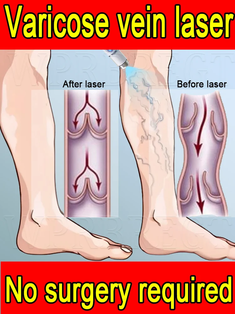 2nd generation varicose vein laser eliminates vasculitis and phlebitis, relieves spider leg pain, laser pointer for treatment
2nd generation varicose vein laser eliminates vasculitis and phlebitis, relieves spider leg pain, laser pointer for treatment