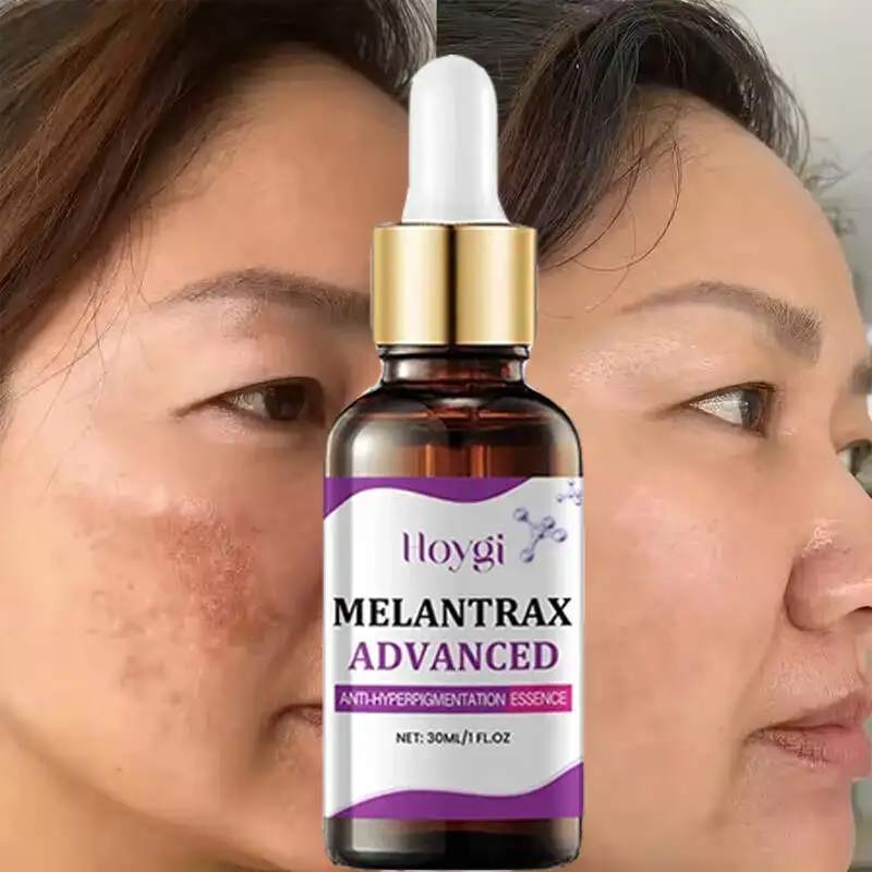 Powerful Dark Spots Remover Freckle Whitening Serum Melanin Correcting Anti Pigmentation Brighten Korean Day Night Facial Care
Powerful Dark Spots Remover Freckle Whitening Serum Melanin Correcting Anti Pigmentation Brighten Korean Day Night Facial Care