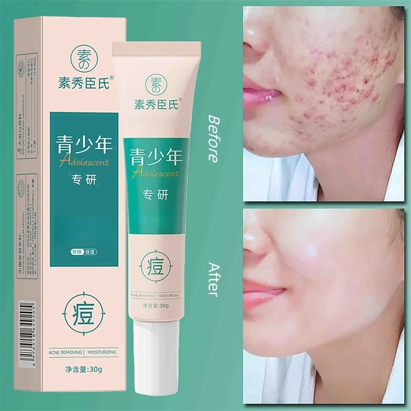 Herbal Acne Removal Face Cream Oil Control Moisturizing Soothing Skin Improve Acne Marks Pores Rough Skin Brighten Care Beauty
Herbal Acne Removal Face Cream Oil Control Moisturizing Soothing Skin Improve Acne Marks Pores Rough Skin Brighten Care Beauty