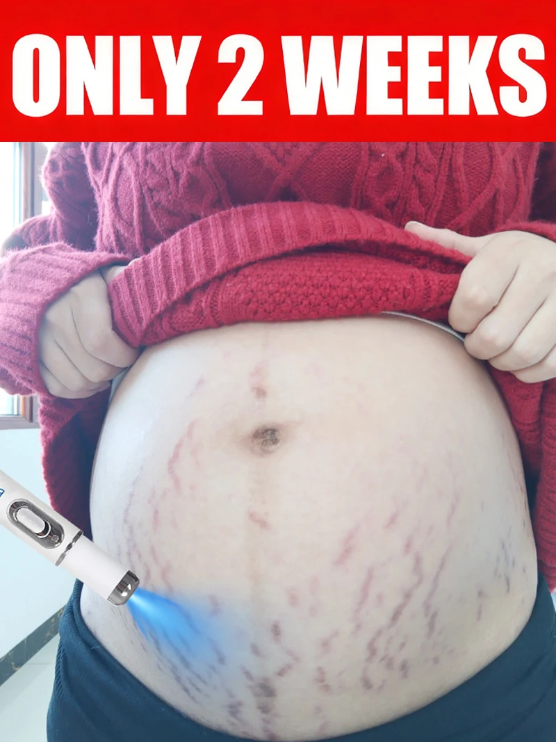 Striae blue light tool Goodbye To Stretch Marks, Maternal Skincare Tools
Striae blue light tool Goodbye To Stretch Marks, Maternal Skincare Tools