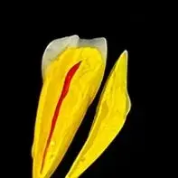 Патологическая модель реставрации зубной целлюлозы, стоматологическая модель, эндодонтические патологические передние лабиновые обучающие модели зубов
Патологическая модель реставрации зубной целлюлозы, стоматологическая модель, эндодонтические патологические передние лабиновые обучающие модели зубов