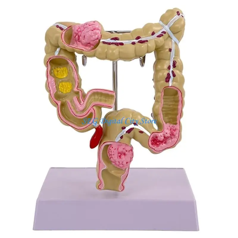 U75B Human Pathologies of Large Intestine Model Medicals Teaching Tool Human Large Intestine Model Human Anatomy Model
U75B Human Pathologies of Large Intestine Model Medicals Teaching Tool Human Large Intestine Model Human Anatomy Model