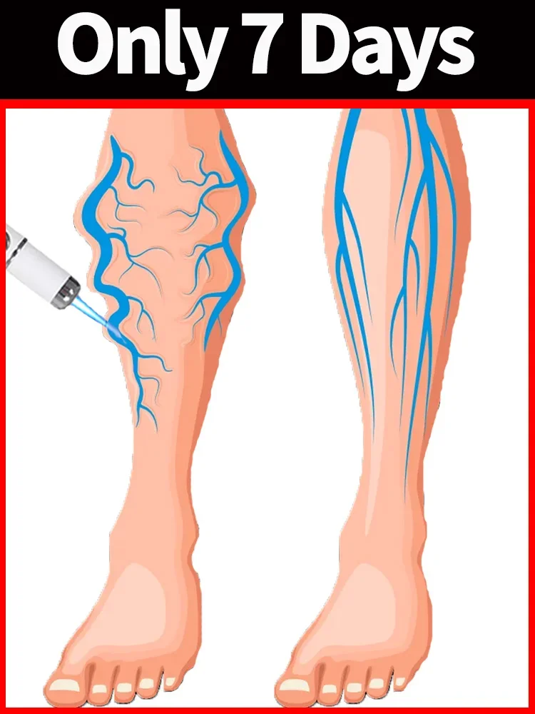 Say goodbye to varicose veins and spider legs in 7 days
Say goodbye to varicose veins and spider legs in 7 days