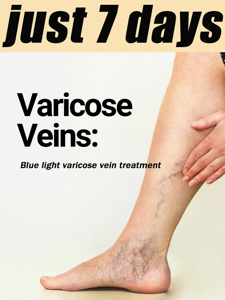 Vᴀʀɪᴄᴏsᴇ ᴠᴇɪɴ ʙʟᴜᴇ ʟɪɢʜᴛ. sᴀʏ ɢᴏᴏᴅʙʏᴇ ᴛᴏ sᴘɪᴅᴇʀ ᴠᴇɪɴs ᴀɴᴅ ʟᴇɢ ᴘᴀɪɴ ᴇᴀsɪʟʏ
Vᴀʀɪᴄᴏsᴇ ᴠᴇɪɴ ʙʟᴜᴇ ʟɪɢʜᴛ. sᴀʏ ɢᴏᴏᴅʙʏᴇ ᴛᴏ sᴘɪᴅᴇʀ ᴠᴇɪɴs ᴀɴᴅ ʟᴇɢ ᴘᴀɪɴ ᴇᴀsɪʟʏ