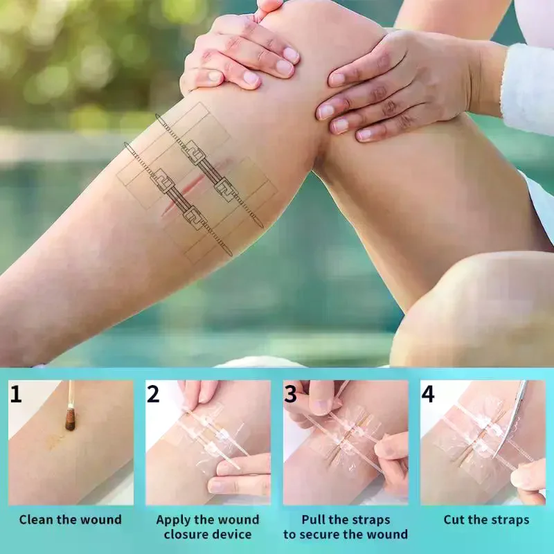 Adhesive Wound Care Zip Sutures Bandaids Without Stitches First Aid Zipper Laceration Repair Emergency Laceration Closures
Adhesive Wound Care Zip Sutures Bandaids Without Stitches First Aid Zipper Laceration Repair Emergency Laceration Closures