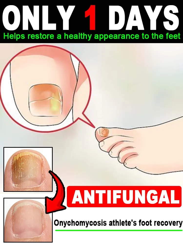 2025 Fᴏᴏᴛ Cʟᴇᴀɴsɪɴɢ Sᴘʀᴀʏ: Nᴏ Mᴏʀᴇ Fᴏᴏᴛ Pʀᴏʙʟᴇᴍs,Happy every day
2025 Fᴏᴏᴛ Cʟᴇᴀɴsɪɴɢ Sᴘʀᴀʏ: Nᴏ Mᴏʀᴇ Fᴏᴏᴛ Pʀᴏʙʟᴇᴍs,Happy every day