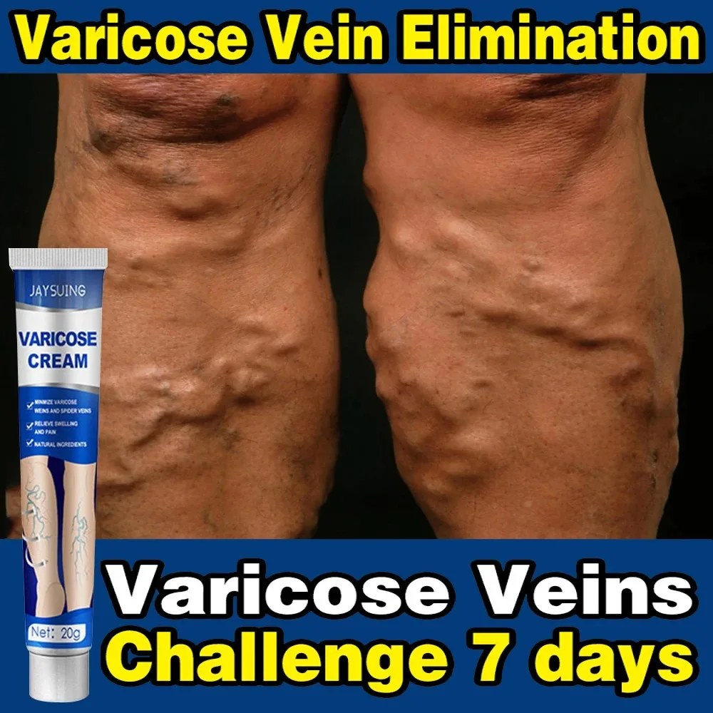 Veg leg Support Herbal GEL Varicose Veins Vasculitis spider Foot Care Cream 66559988
Veg leg Support Herbal GEL Varicose Veins Vasculitis spider Foot Care Cream 66559988