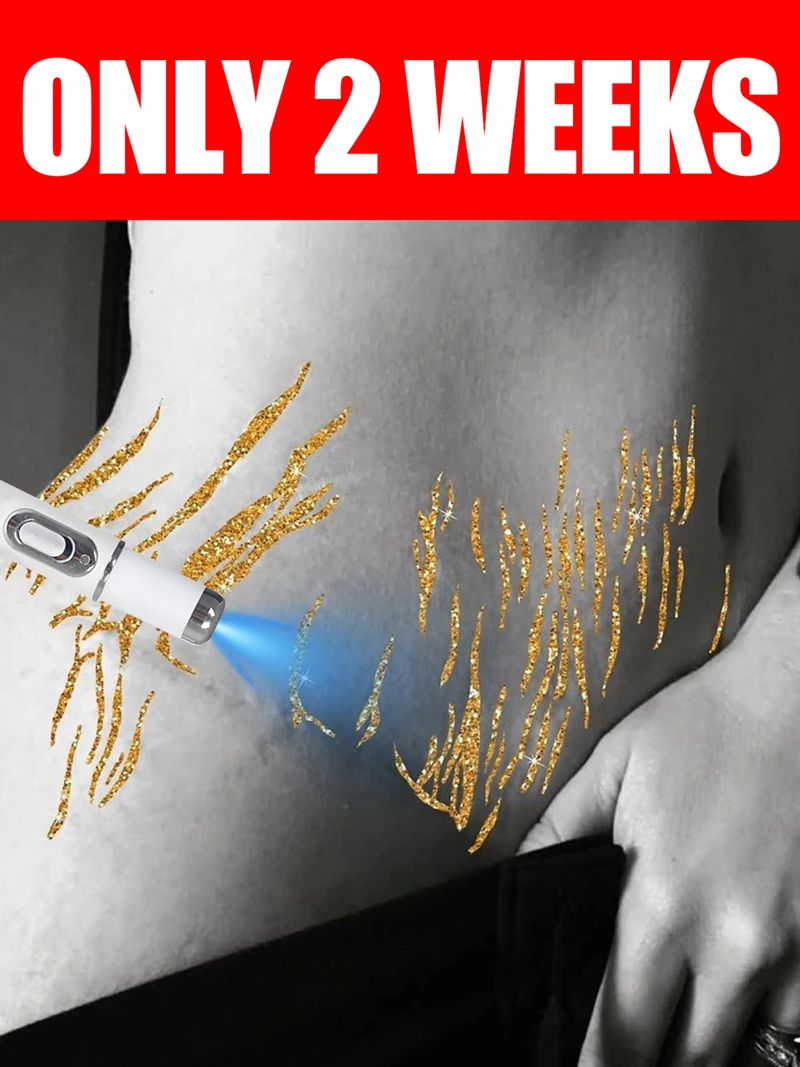 blue light pen to solve body Stretch Marks, Maternal Skincare Tools
blue light pen to solve body Stretch Marks, Maternal Skincare Tools