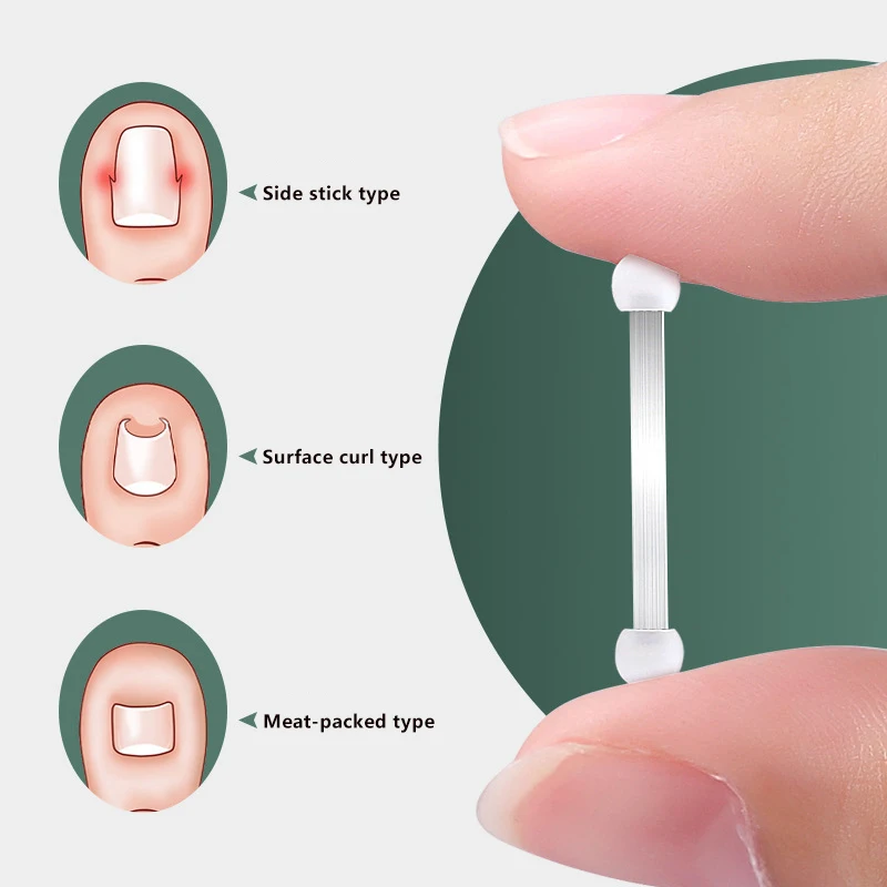 Ingrown Toenail Recover Pedicure Tool Toe Braces Toenail Straightener Toenail Fixer Bunion Corrector Ingrown Toenails Corrector
Ingrown Toenail Recover Pedicure Tool Toe Braces Toenail Straightener Toenail Fixer Bunion Corrector Ingrown Toenails Corrector