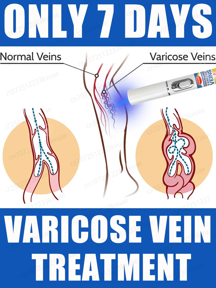 blue light pen solve varicose veins, hot sale leg care tools 
blue light pen solve varicose veins, hot sale leg care tools