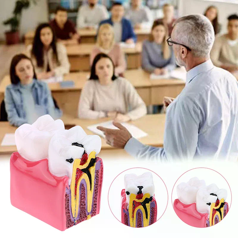 6 Times Dental Caries Model Disease Teeth Dental Model For Dental Demonstration Model Dentist Teaching Dental Lab Oral Research
6 Times Dental Caries Model Disease Teeth Dental Model For Dental Demonstration Model Dentist Teaching Dental Lab Oral Research