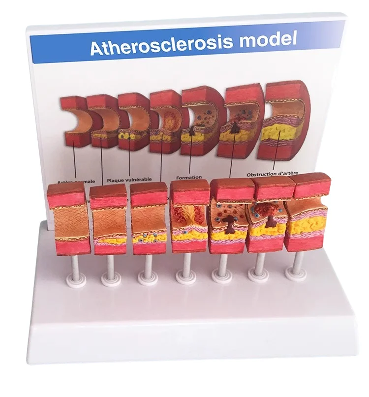 Atherosclerosis Medical Model Artery Pathology Artery Anatomical Model Blood Vessel Anatomy Thrombus Blood Fat Model Medical Aid
Atherosclerosis Medical Model Artery Pathology Artery Anatomical Model Blood Vessel Anatomy Thrombus Blood Fat Model Medical Aid