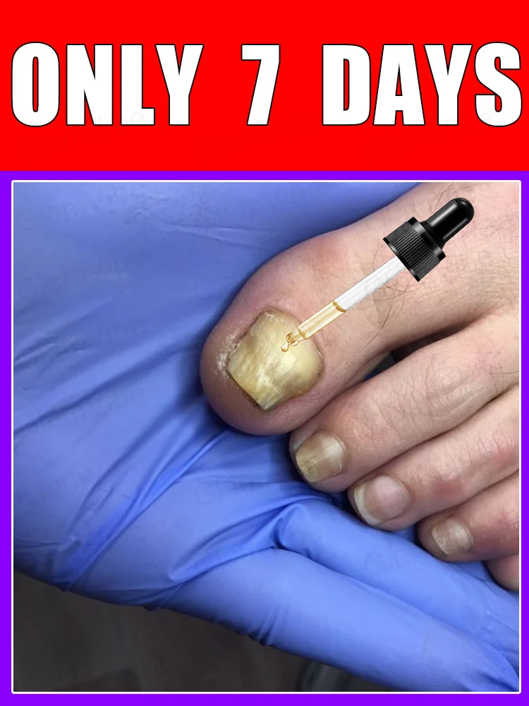 2025 Toenail Fungus Patch Waterproof Nail Repair Patches Nail Ingrown Correction Sticker Discolored Damaged Nail Foot Care Tool
2025 Toenail Fungus Patch Waterproof Nail Repair Patches Nail Ingrown Correction Sticker Discolored Damaged Nail Foot Care Tool