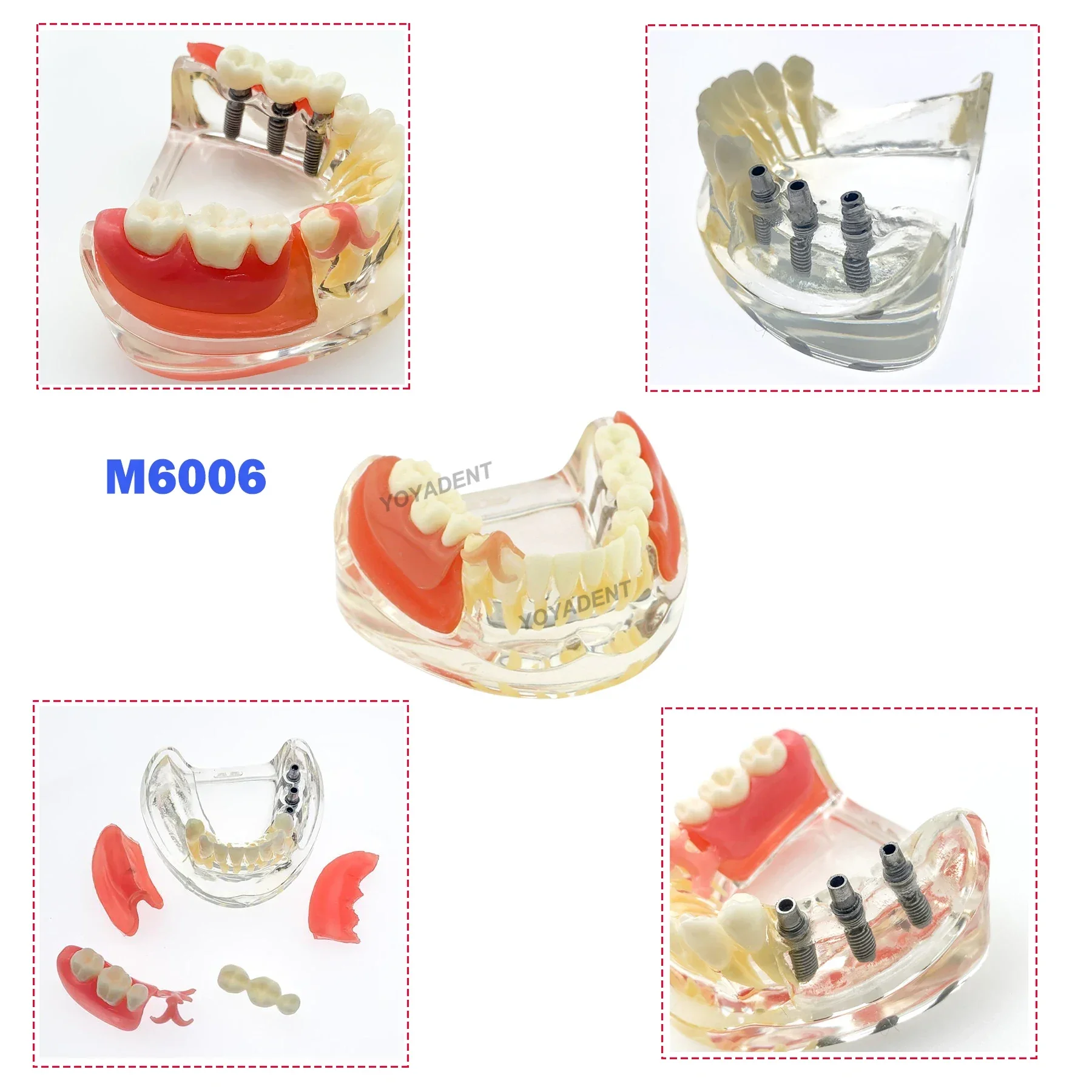 Dental Teeth Model With 3 Lower Jaw Implants Removable Bridge Dentist Patient Communication Demo Dental Teaching Model
Dental Teeth Model With 3 Lower Jaw Implants Removable Bridge Dentist Patient Communication Demo Dental Teaching Model