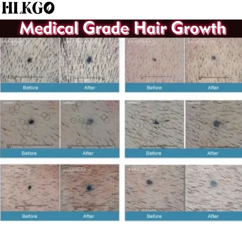 Medical Grade LLLT Laser Cap Helmet 650nm, Hair Regrowth Therapy Device for Follicle Activation and Thicker Hair Home
Medical Grade LLLT Laser Cap Helmet 650nm, Hair Regrowth Therapy Device for Follicle Activation and Thicker Hair Home