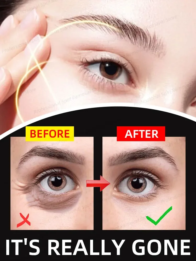 Fast Eye Bag Remover Retinol Anti-wrinkle Firming Skin Lightening Fine Lines Anti-dark circles Puffiness Bright Eye Care
Fast Eye Bag Remover Retinol Anti-wrinkle Firming Skin Lightening Fine Lines Anti-dark circles Puffiness Bright Eye Care