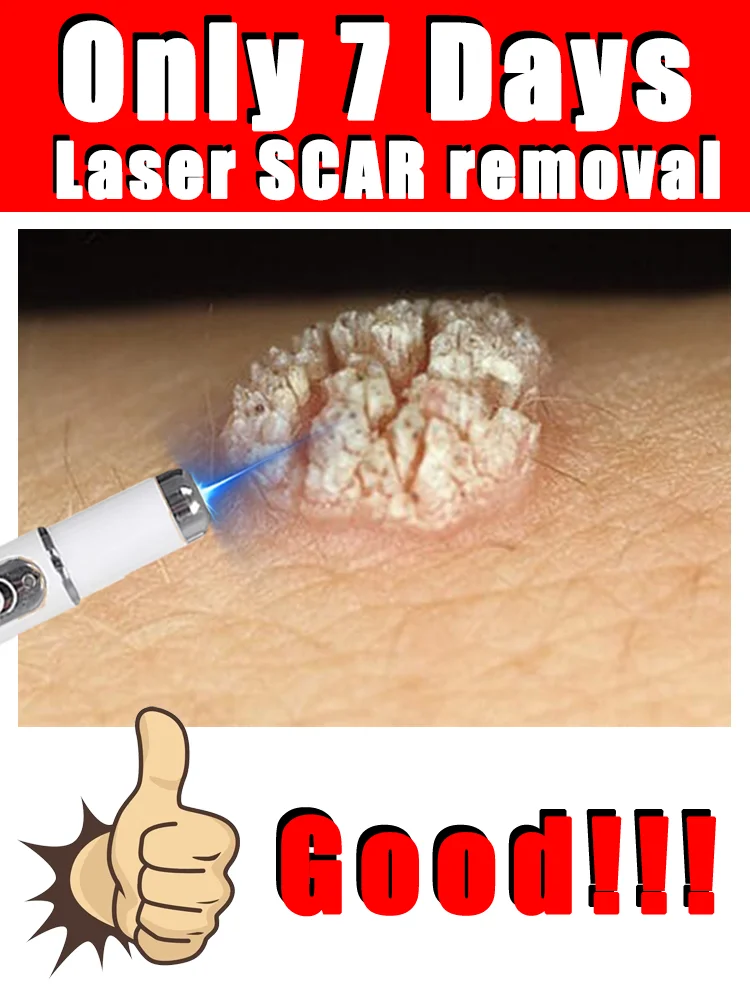 blue light pen solve warts,unisex,Free shipping,wart care tools
blue light pen solve warts,unisex,Free shipping,wart care tools