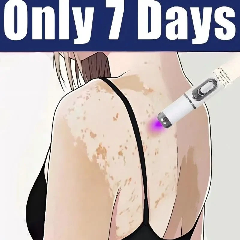 Лазер второго поколения: Прощай, витилиго, через 7 дней!
Лазер второго поколения: Прощай, витилиго, через 7 дней!