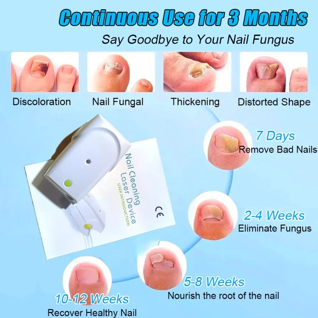 Nail Fungus Killer Device - Home Use Laser Diodes Therapy for Toenail Fungus Treatment and Onychomycosis Cleaning Care Tool
Nail Fungus Killer Device - Home Use Laser Diodes Therapy for Toenail Fungus Treatment and Onychomycosis Cleaning Care Tool