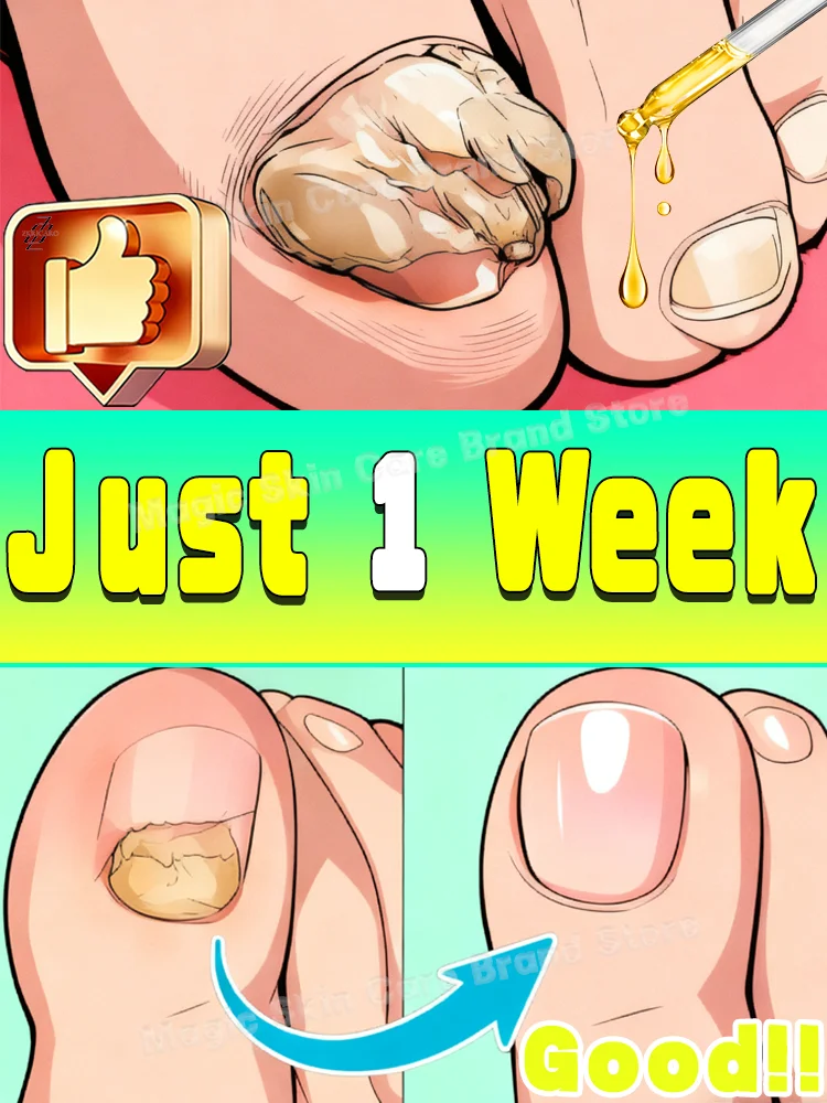 Restore natural nail shine, fast-penetrating, fungal nail cleaning tool
Restore natural nail shine, fast-penetrating, fungal nail cleaning tool