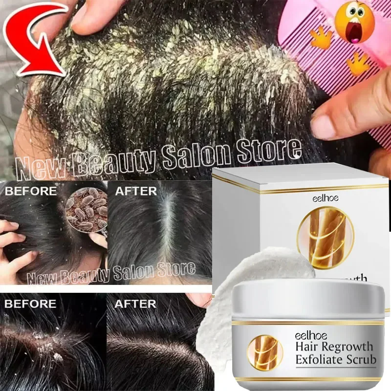 Fast Anti Exfoliating Scrub Remove Dandruff Anti Itching Treatment Seborrheic Scalp Oil Control Repair Scalp Beauty Health Care
Fast Anti Exfoliating Scrub Remove Dandruff Anti Itching Treatment Seborrheic Scalp Oil Control Repair Scalp Beauty Health Care
