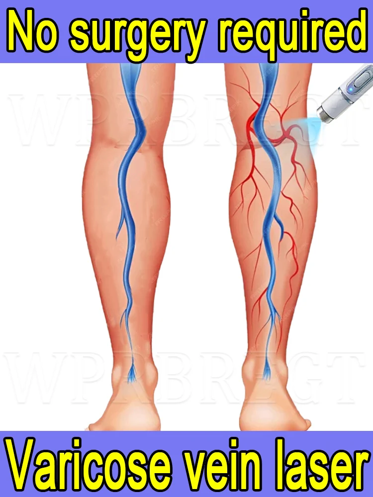 Varicose vein laser pen: eliminate vasculitis and phlebitis, relieve spider leg pain, painless laser treatment
Varicose vein laser pen: eliminate vasculitis and phlebitis, relieve spider leg pain, painless laser treatment