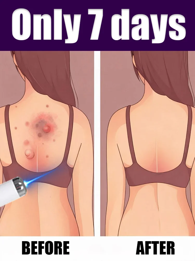 Laser pen for eradicating warts on the whole body and raised areas
Laser pen for eradicating warts on the whole body and raised areas