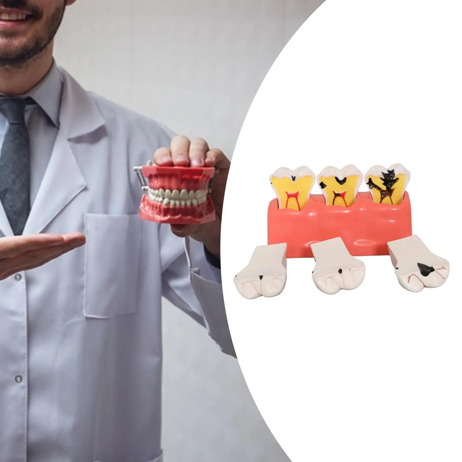 Decayed Tooth Model with Three Stage Decay Educational Toy for Student Demonstration
Decayed Tooth Model with Three Stage Decay Educational Toy for Student Demonstration