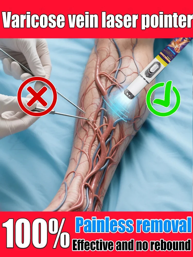 Generation Varicose Vein 3nd Laser Pointer Treatment Laser Relieves Spider Leg Pain Tool
Generation Varicose Vein 3nd Laser Pointer Treatment Laser Relieves Spider Leg Pain Tool