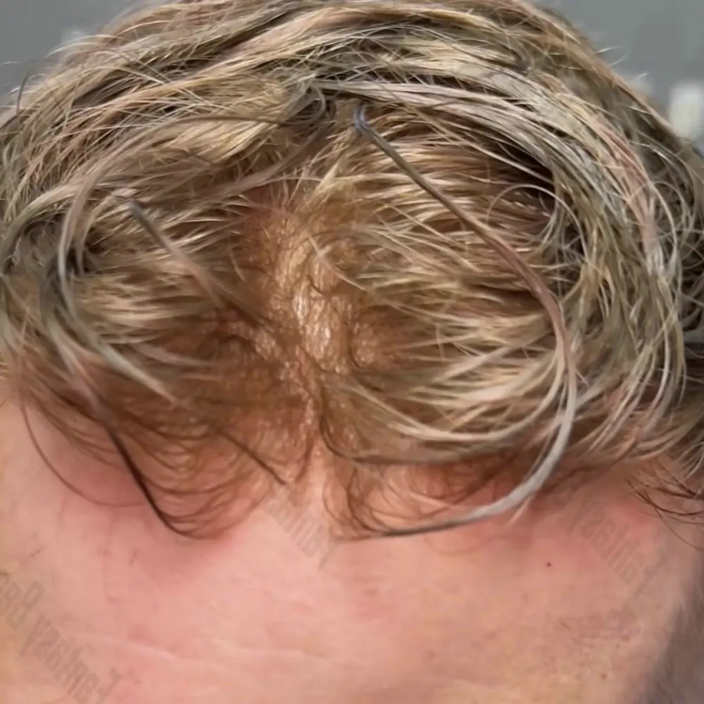 V-Loop Invisible 0.02mm Super Thin Skin Base Remy Human Hair Men Toupee Natural Front Hairline Men's Capillary Prosthesis System
V-Loop Invisible 0.02mm Super Thin Skin Base Remy Human Hair Men Toupee Natural Front Hairline Men's Capillary Prosthesis System