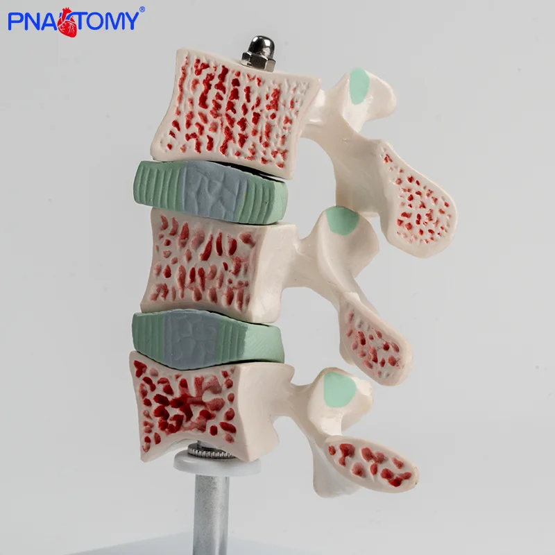 Human Skeletal Osteoporosis Lesion Model Spinal and Cervical Vertebra Anatomical Model
Human Skeletal Osteoporosis Lesion Model Spinal and Cervical Vertebra Anatomical Model