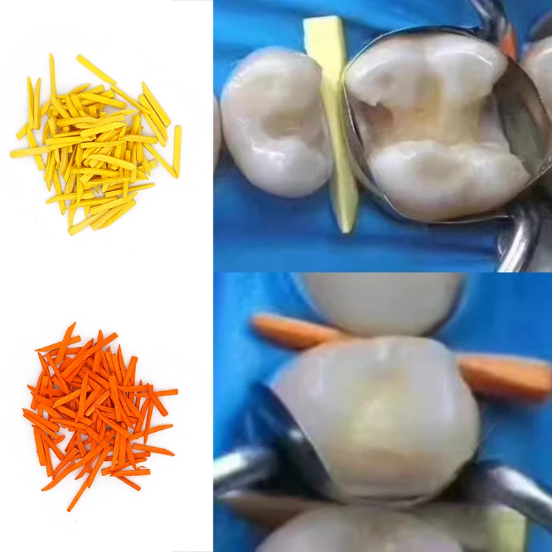 100 шт., стоматологические деревянные клинья, межзубные контурные стоматологические клинья, без расширения, деревянные клинья из водяного клена, стоматология
100 шт., стоматологические деревянные клинья, межзубные контурные стоматологические клинья, без расширения, деревянные клинья из водяного клена, стоматология