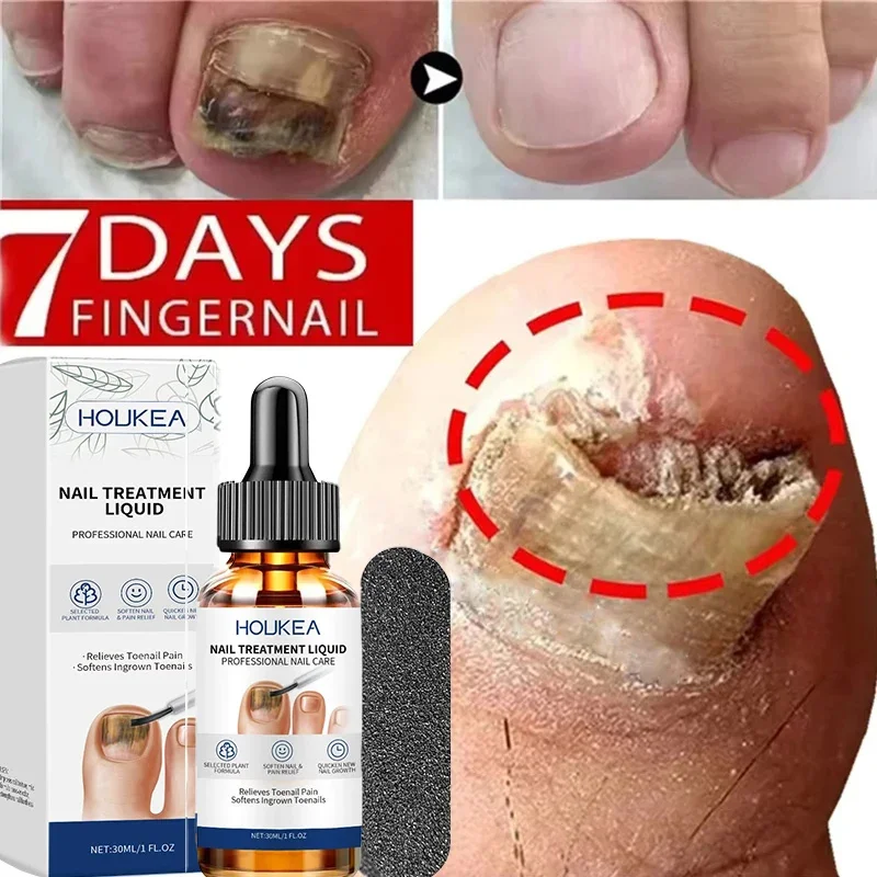 Nail Fungus Treatment Serum Foot Repair Liquid Toe Nails Fungal Removal Gel Anti Infection Paronychia Onychomycosis Cream 30ml
Nail Fungus Treatment Serum Foot Repair Liquid Toe Nails Fungal Removal Gel Anti Infection Paronychia Onychomycosis Cream 30ml