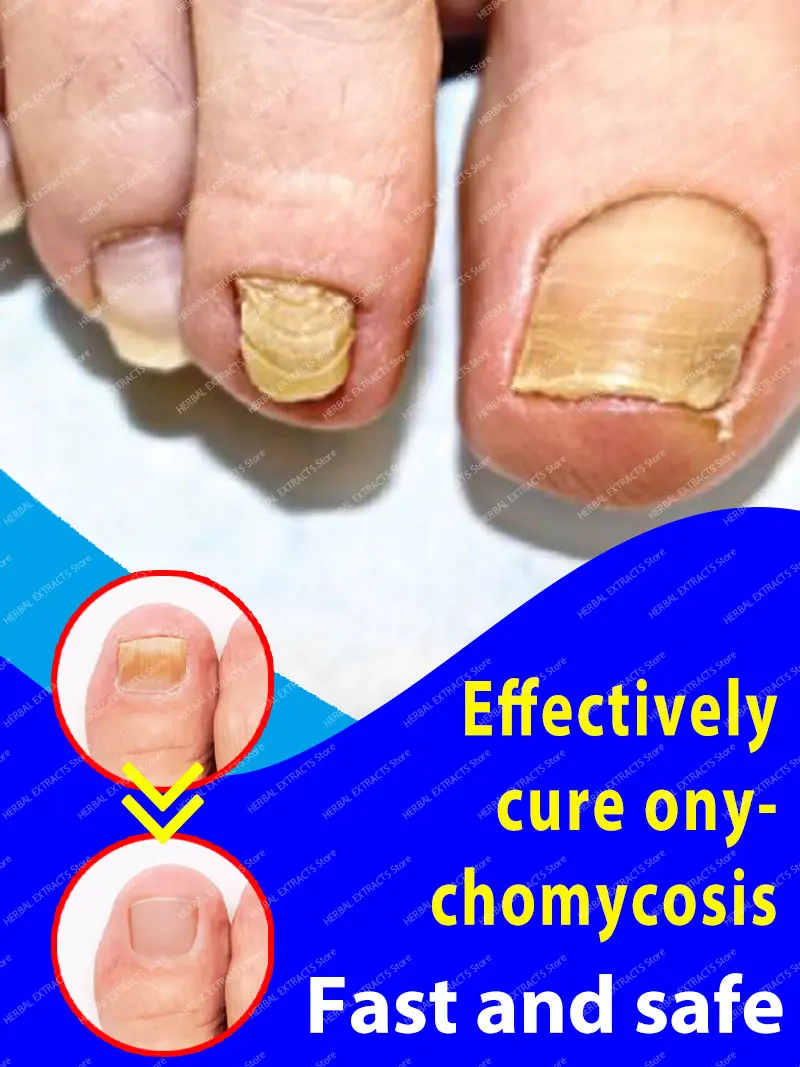 масло для ремонта грибка ногтей
масло для ремонта грибка ногтей