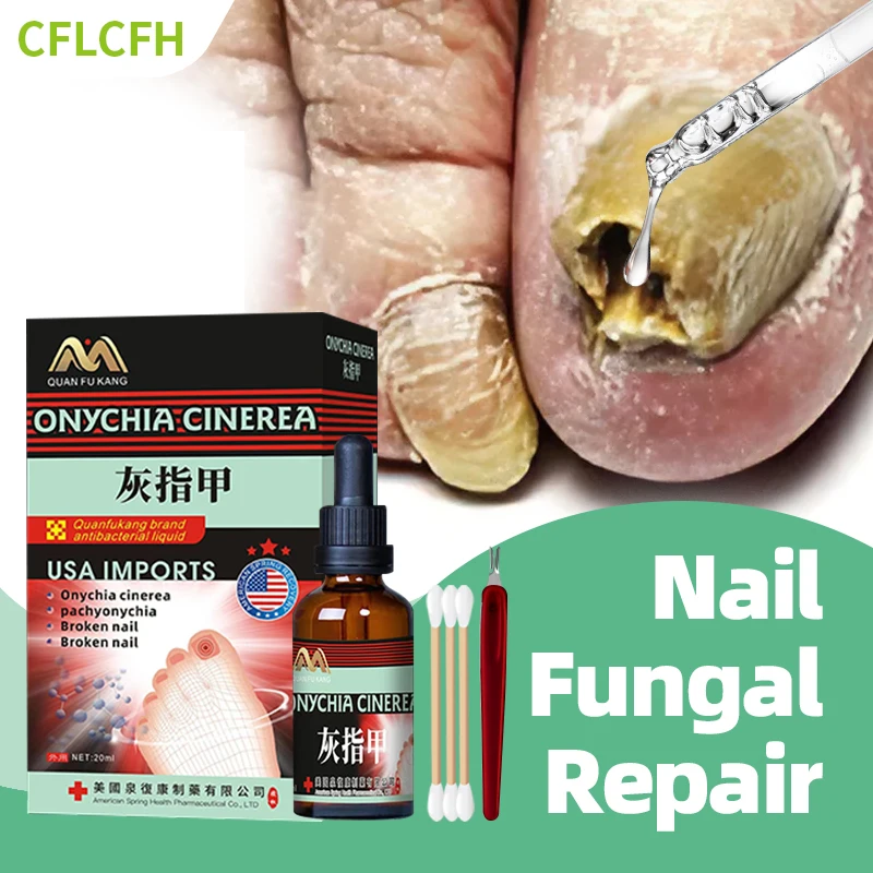 Fungal Nail Treatment Paronychia Cleaner Toe Nail Fungus Correction Liquid Onychomycosis Foot Care Medicine American Formula
Fungal Nail Treatment Paronychia Cleaner Toe Nail Fungus Correction Liquid Onychomycosis Foot Care Medicine American Formula