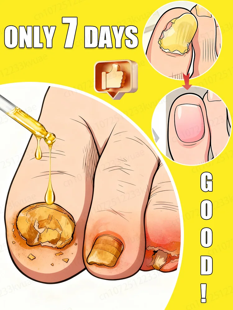 Tᴏᴇɴᴀɪʟ Fᴜɴɢᴜs Pᴀᴛᴄʜᴇs Rᴇᴘᴀɪʀ Dɪsᴄᴏʟᴏʀᴇᴅ Dᴀᴍᴀɢᴇᴅ Nᴀɪʟs Fᴏᴏᴛ Cᴀʀ
Tᴏᴇɴᴀɪʟ Fᴜɴɢᴜs Pᴀᴛᴄʜᴇs Rᴇᴘᴀɪʀ Dɪsᴄᴏʟᴏʀᴇᴅ Dᴀᴍᴀɢᴇᴅ Nᴀɪʟs Fᴏᴏᴛ Cᴀʀ