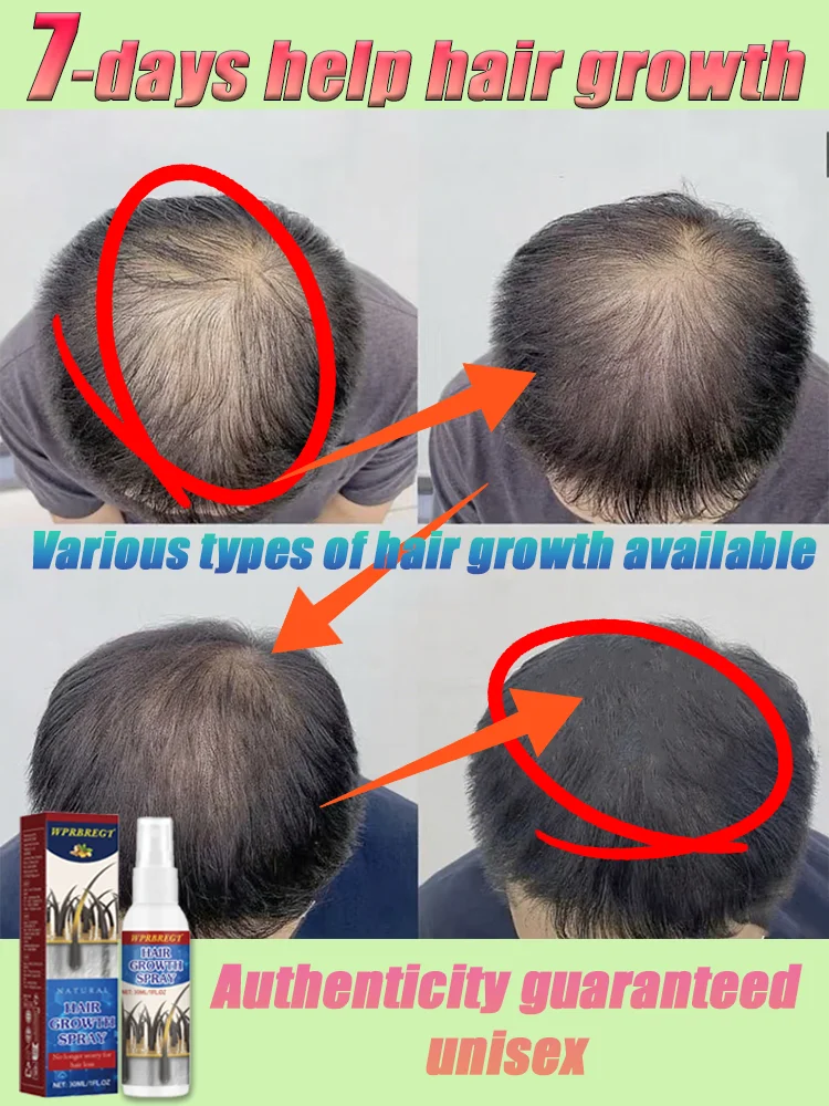 Gɪɴɢᴇʀ ᴇssᴇɴᴄᴇ ʜᴀɪʀ ɢʀᴏᴡᴛʜ sᴘʀᴀʏ, ᴛʜɪᴄᴋᴇɴs ʜᴀɪʀ ᴀɴᴅ ʀᴇᴅᴜᴄᴇs ʜᴀɪʀ ʟᴏss
Gɪɴɢᴇʀ ᴇssᴇɴᴄᴇ ʜᴀɪʀ ɢʀᴏᴡᴛʜ sᴘʀᴀʏ, ᴛʜɪᴄᴋᴇɴs ʜᴀɪʀ ᴀɴᴅ ʀᴇᴅᴜᴄᴇs ʜᴀɪʀ ʟᴏss