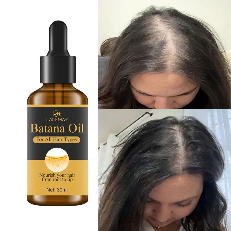 Fast Batana Oil Hair Growth Serum Anti-loss Hair Regrowth Products Repair Damaged Hair Roots Hair Care For Women Men
Fast Batana Oil Hair Growth Serum Anti-loss Hair Regrowth Products Repair Damaged Hair Roots Hair Care For Women Men