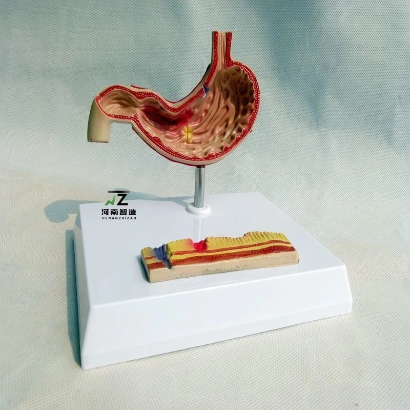 Pathological stomach model, perforated sick stomach model of the human stomach Human digestive system
Pathological stomach model, perforated sick stomach model of the human stomach Human digestive system