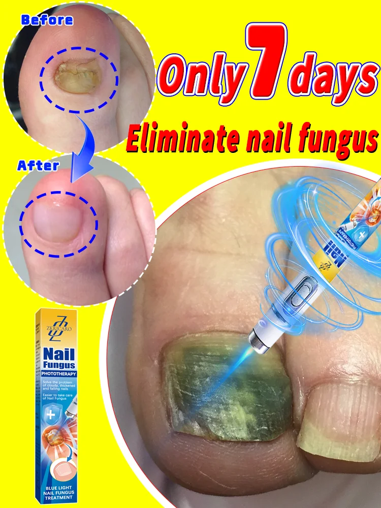 The most effective nail fungus product of the new era, eliminating nail fungus in 7 days. Most people's choice.
The most effective nail fungus product of the new era, eliminating nail fungus in 7 days. Most people's choice.