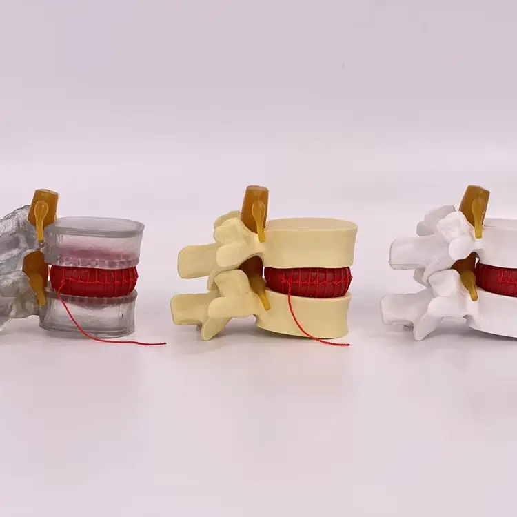 Увеличенный человеческий позвоночник и Поясничный позвоночник, модель патологии, демонстрационная модель поясничного диска модель образования грыжи
Увеличенный человеческий позвоночник и Поясничный позвоночник, модель патологии, демонстрационная модель поясничного диска модель образования грыжи