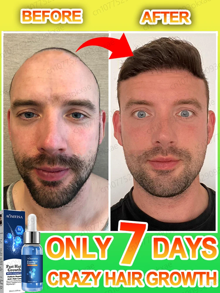 Powerful hair growth Anti-hair loss Anti-baldness Fast hair growth Hair loss treatment Hair regrowth Fast Hair Growth Oil
Powerful hair growth Anti-hair loss Anti-baldness Fast hair growth Hair loss treatment Hair regrowth Fast Hair Growth Oil