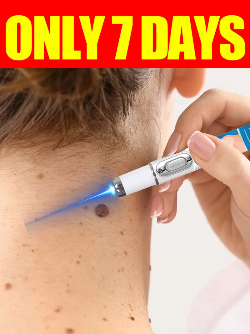 Синий световой карандаш для удаления шипов на шее, инструменты для ухода за генитальными бородавками
Синий световой карандаш для удаления шипов на шее, инструменты для ухода за генитальными бородавками